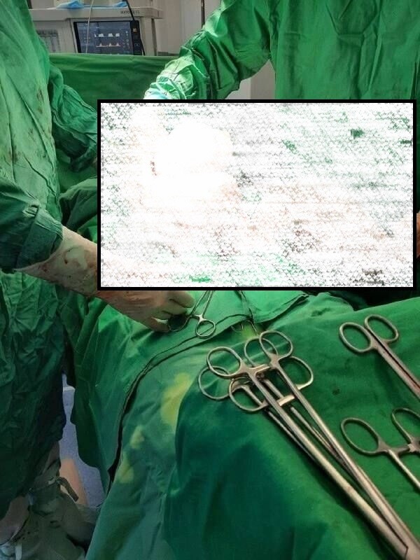 Две огромные опухоли яичников вырезали у женщины врачи из родильного дома в Орехово-Зуево